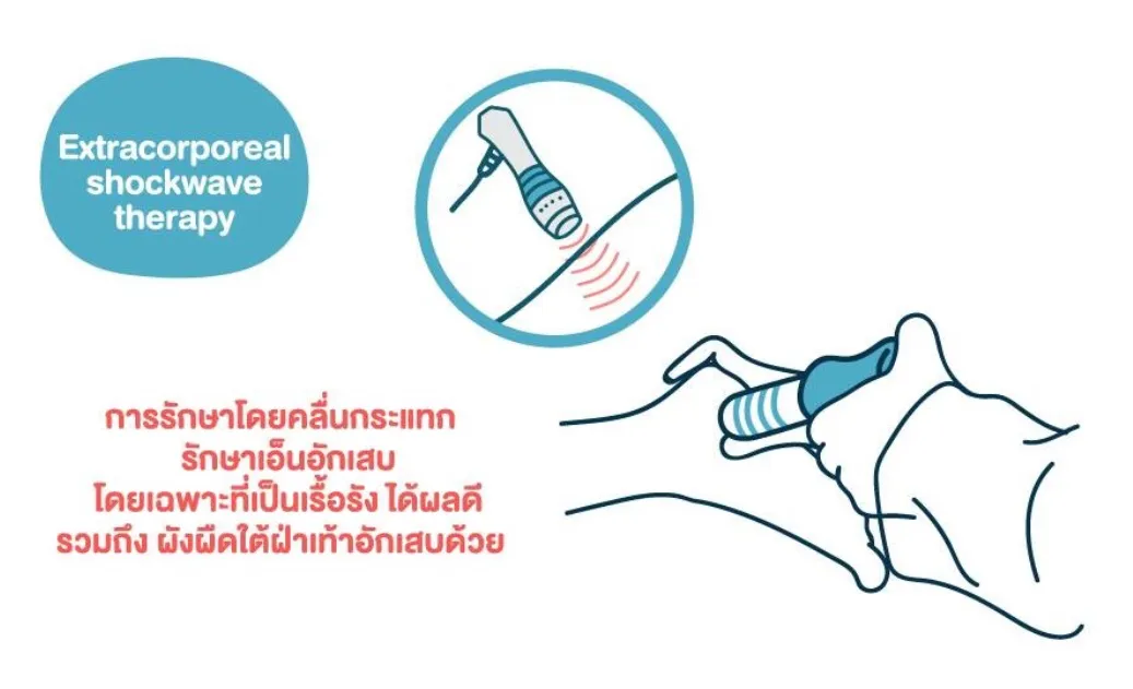 การรักษาโดยคลื่นกระแทก