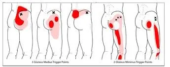 Trigger point