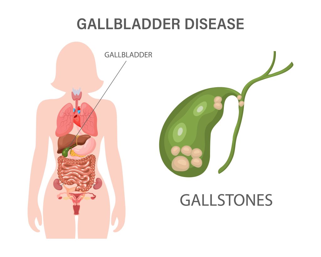Gallstones | BNH